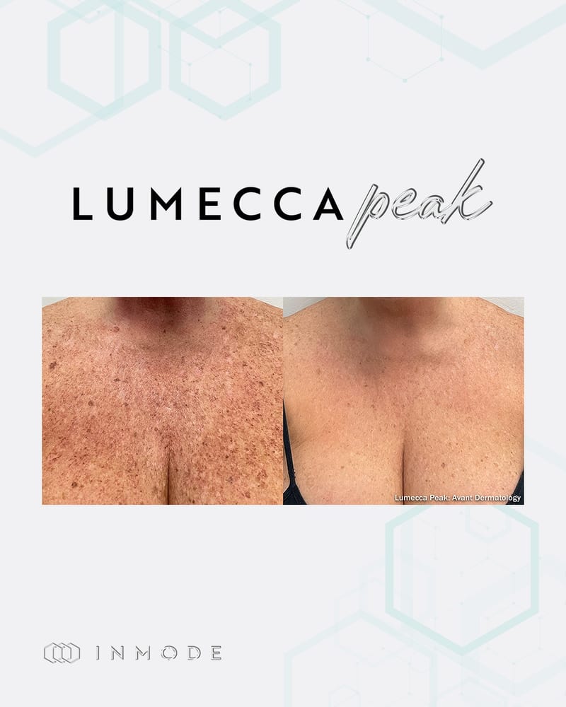 Lumecca Peak, sun damage on the décolletage. Image via InMode.