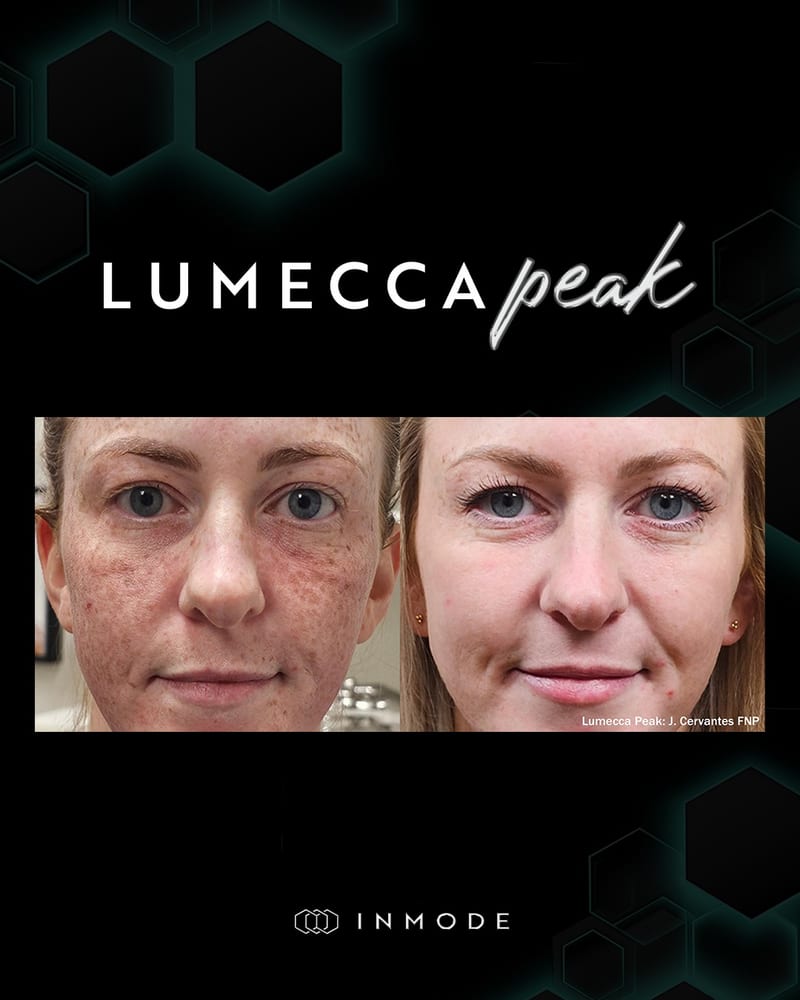 Lumecca Peak, freckles and pigmentation on the face. Image via InMode.