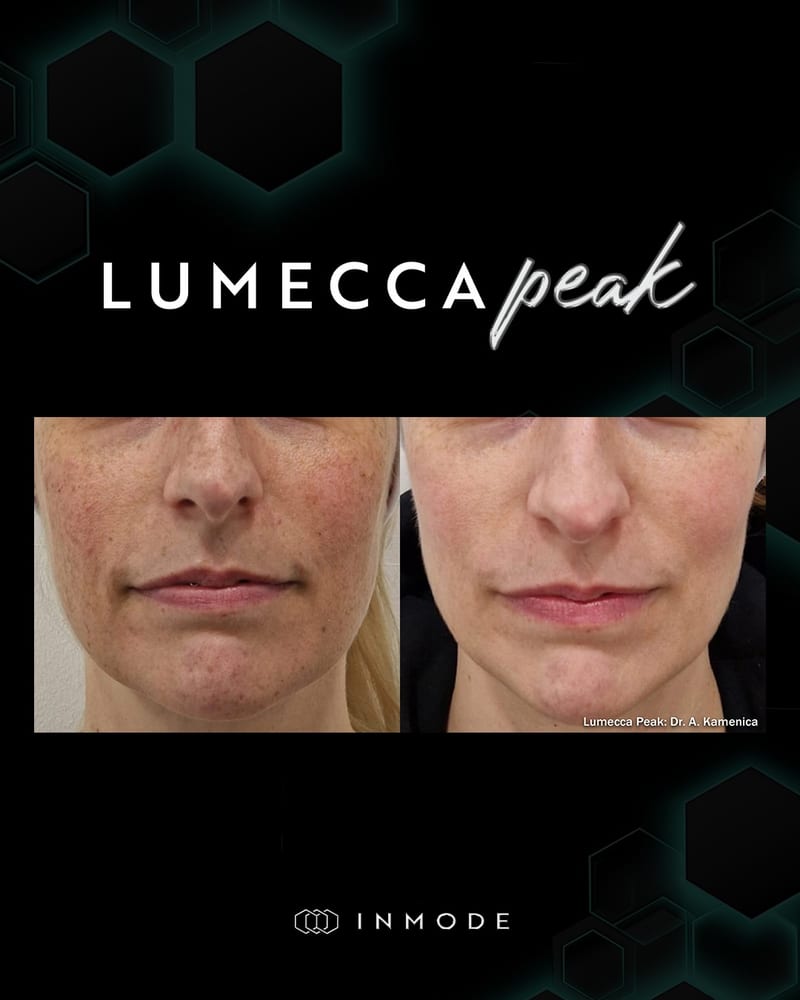 Lumecca Peak, pigmentation on the cheeks and upper lip. Image via InMode.