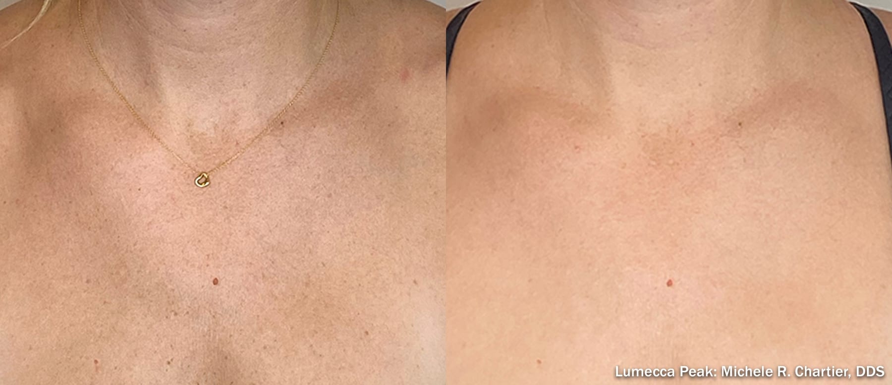 Lumecca Peak, sun damage and redness on the chest. Image: Michele R. Chartier, DDS, via InMode.