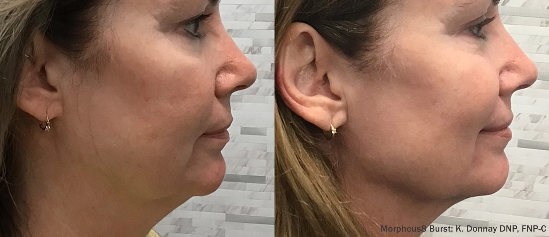 Morpheus8 Burst, lower face and jawline. Image: K. Donnay DNP, FNP-C, via InMode.