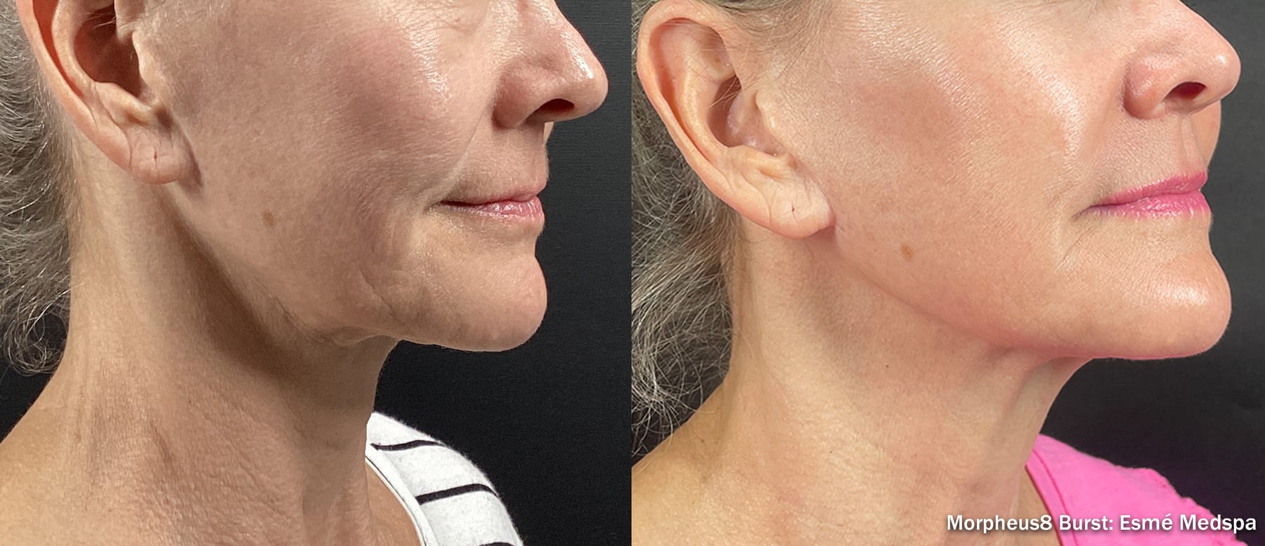 Morpheus8 Burst, lower face and neck after four treatments. Image: Esme Medspa, via InMode.