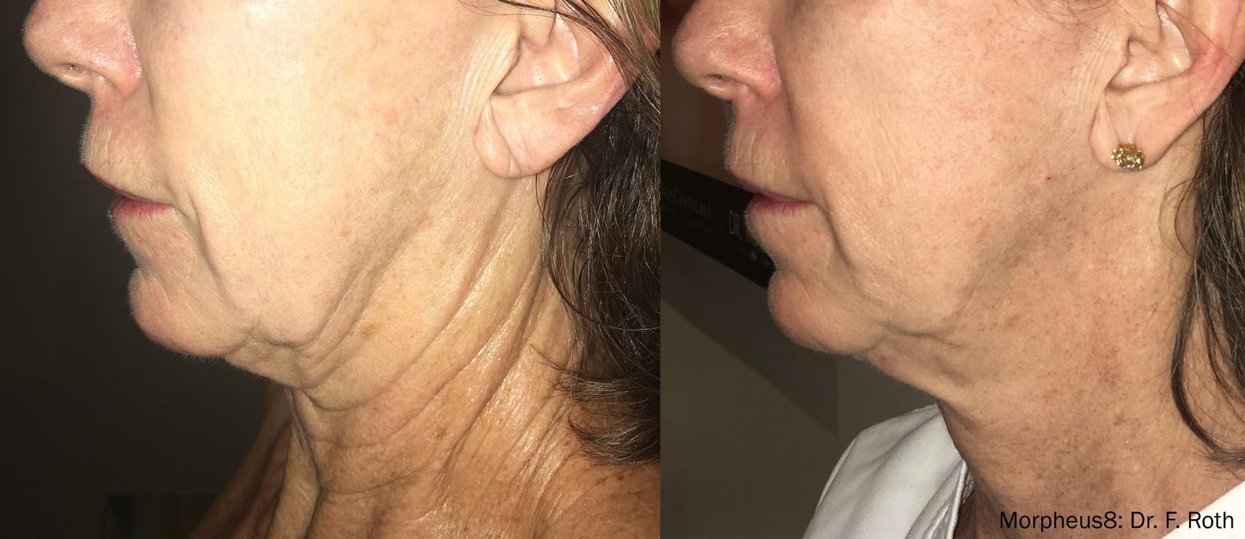 Morpheus8, jawline and neck. Image: Dr F. Roth, via InMode.
