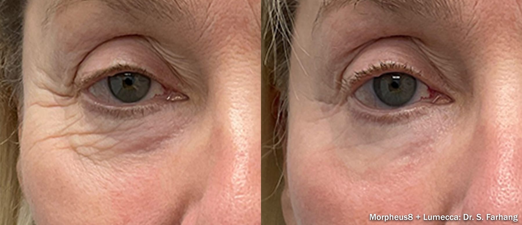 Morpheus8 combined with Lumecca, fine lines and texture around the eye. Image: Dr S. Farhang, via InMode.