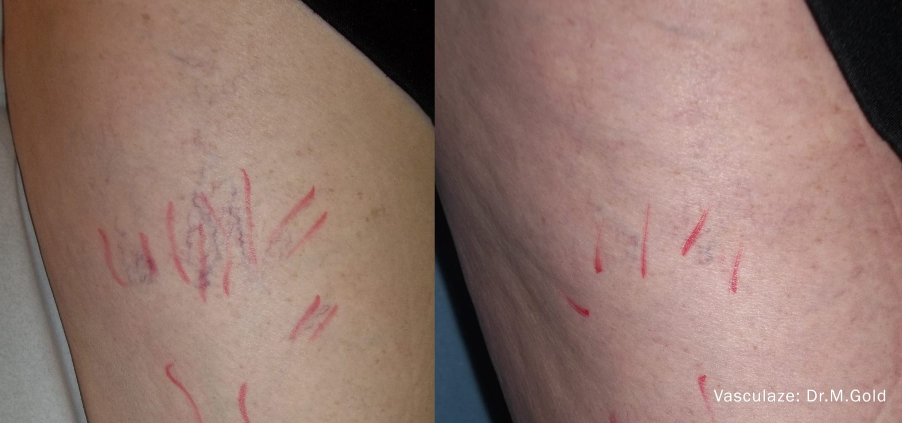 VasculazeMAX, thread veins on the leg. Image: Dr M. Gold, via InMode.