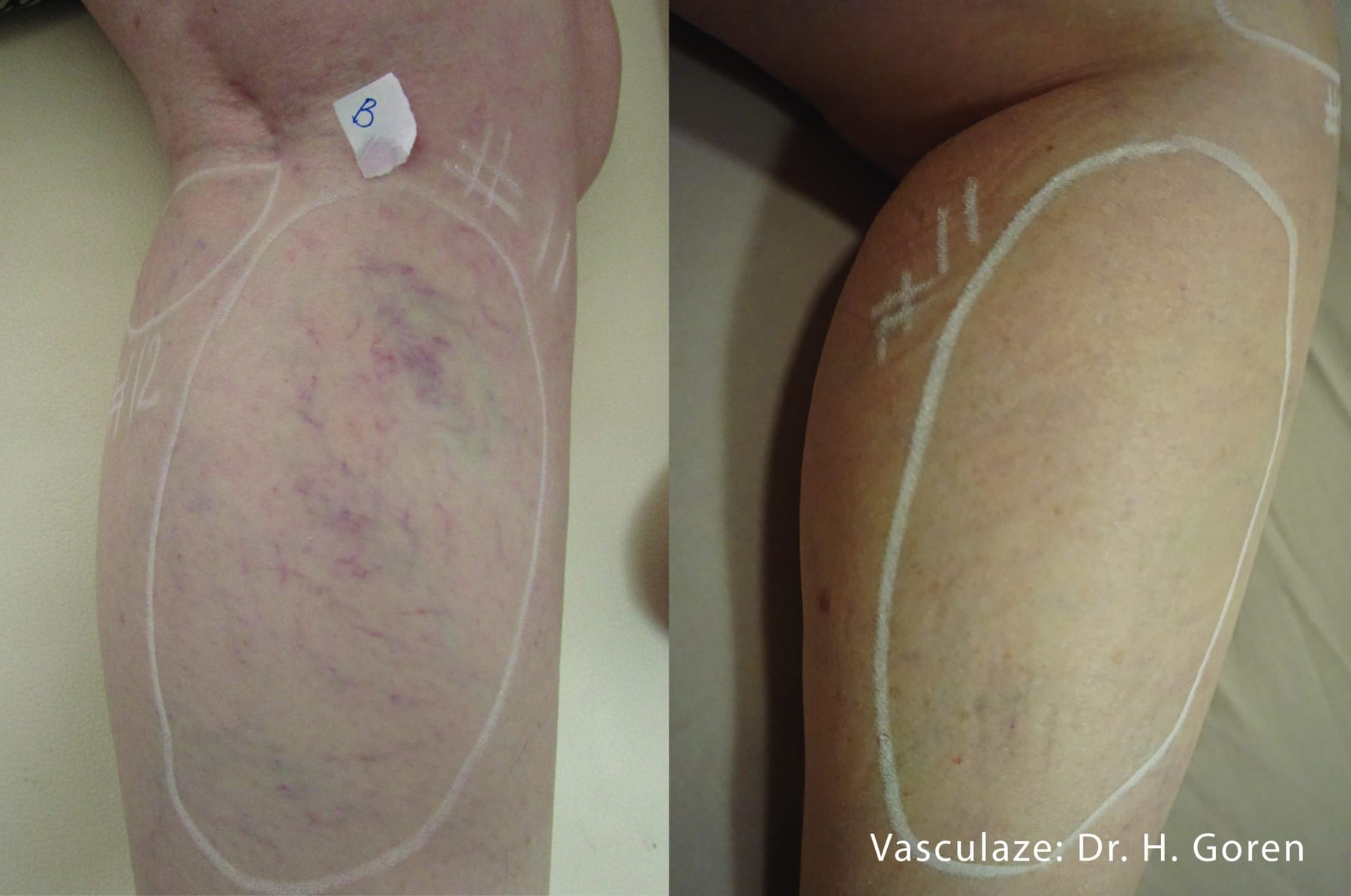 VasculazeMAX, spider veins on the lower leg. Image: Dr H. Goren, via InMode.