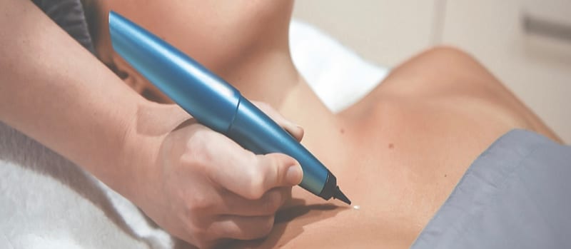 Cryotherapy at Avismo Aesthetics and Skin, St Ives