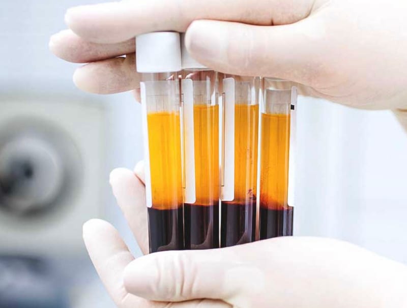 Platelet Rich Plasma (PRP) at Avismo Aesthetics and Skin, St Ives