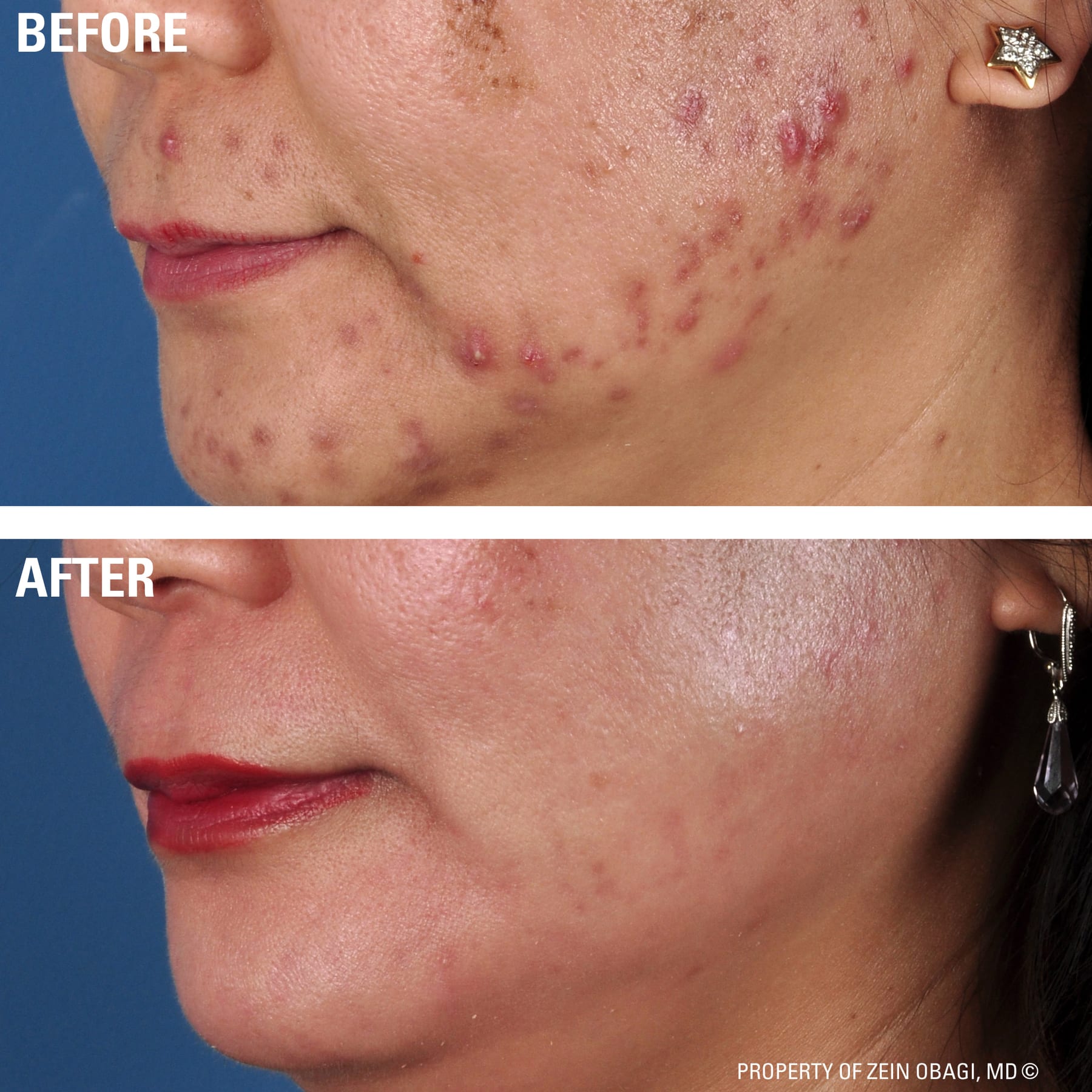 ZO Skin Health for acne and breakouts