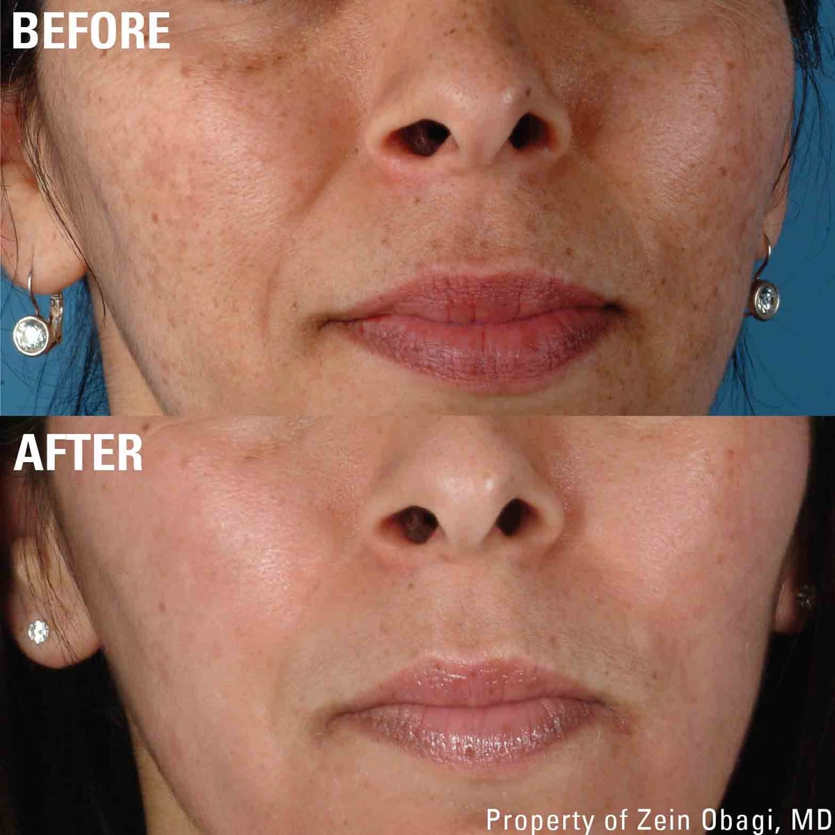 ZO Skin Health for sun damage and pigmentation