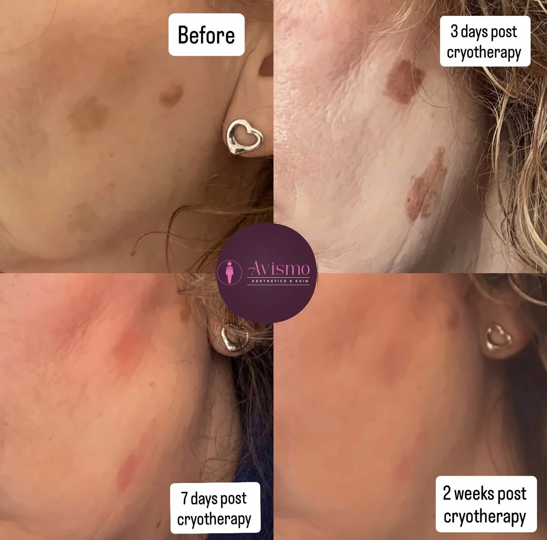 Before and after cryotherapy at Avismo Aesthetics and Skin, St Ives