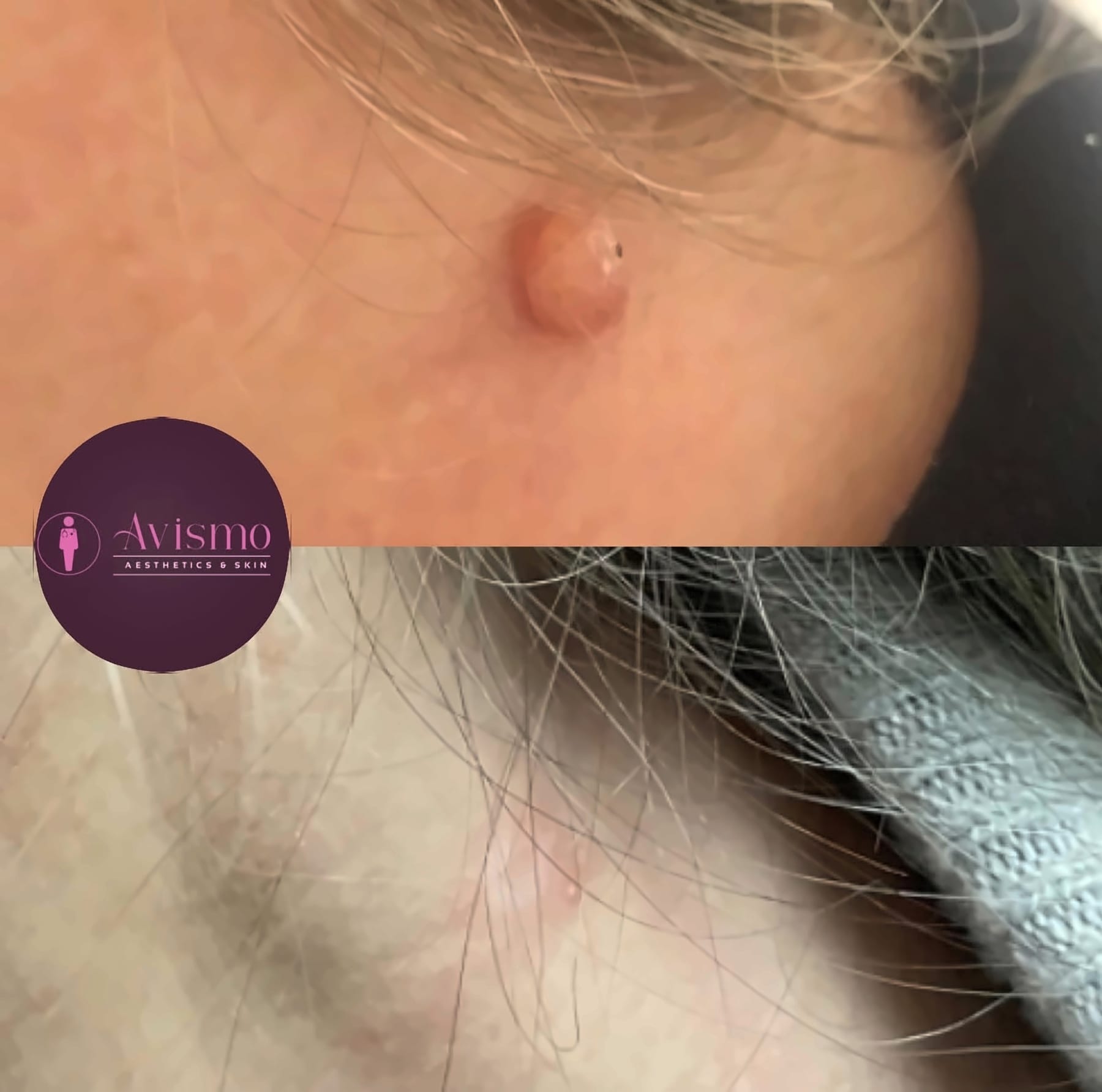 Before and after cryotherapy at Avismo Aesthetics and Skin, St Ives