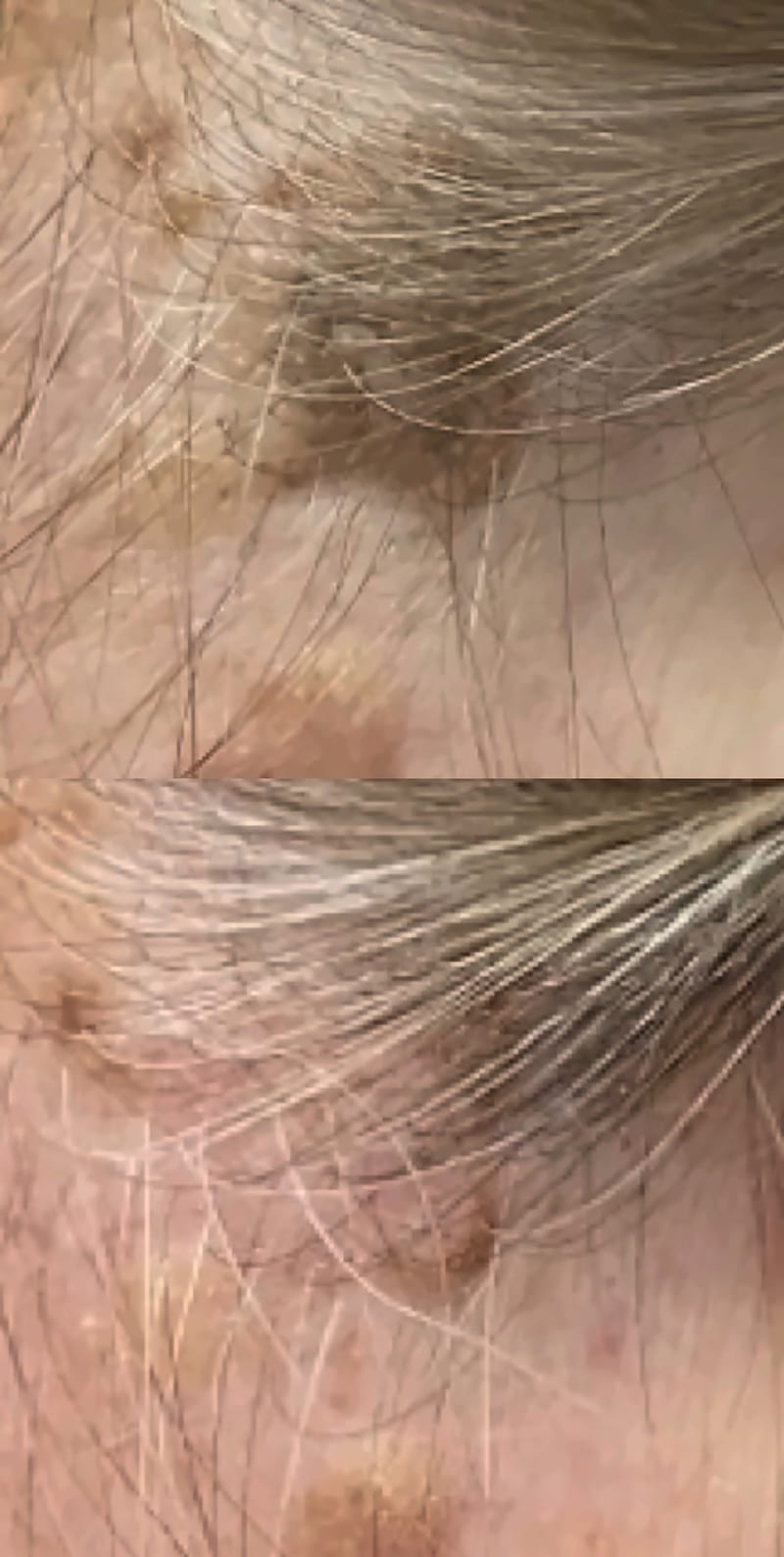 Before and after cryotherapy at Avismo Aesthetics and Skin, St Ives