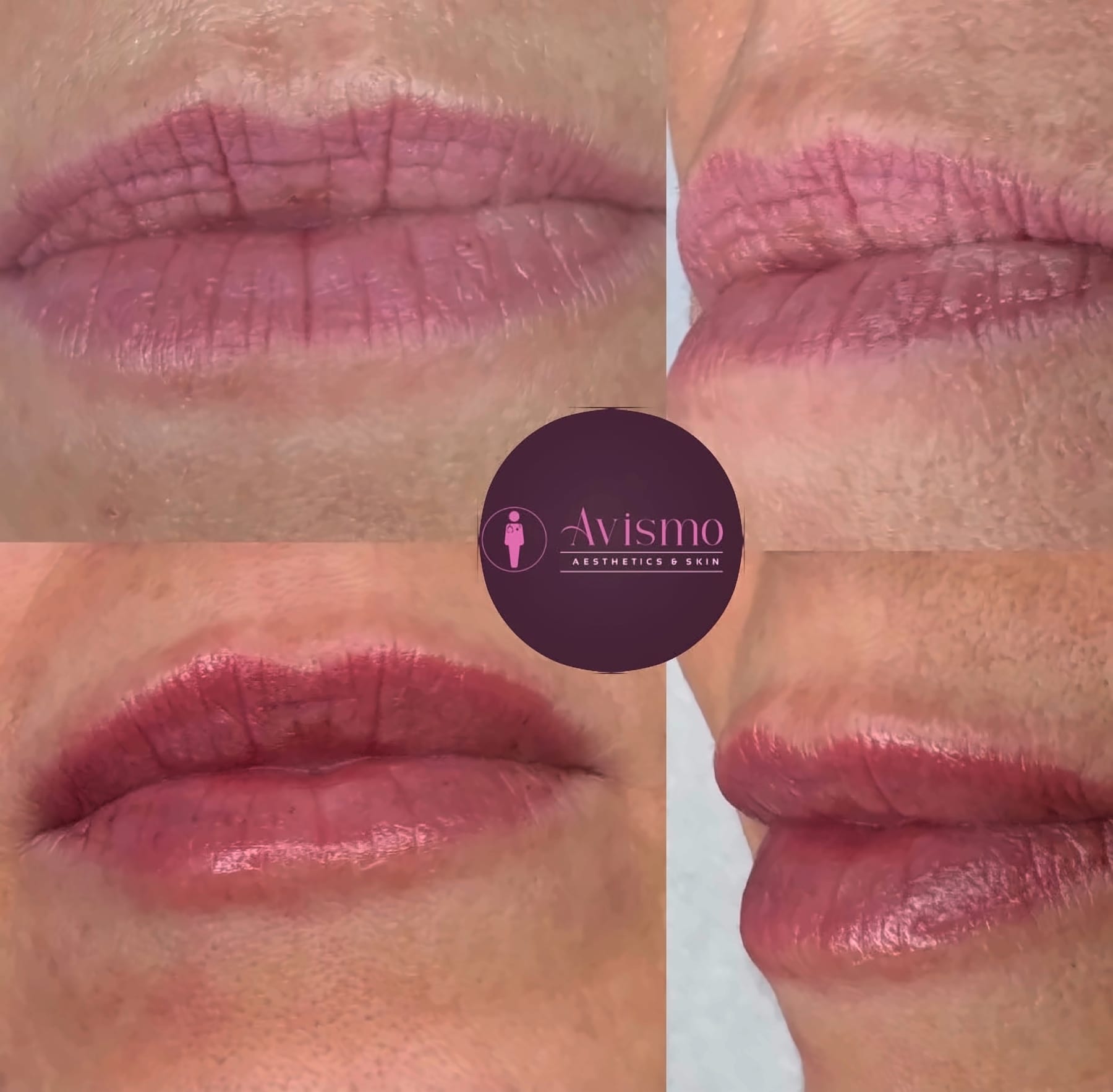 Before and after lip filler at Avismo Aesthetics and Skin, St Ives