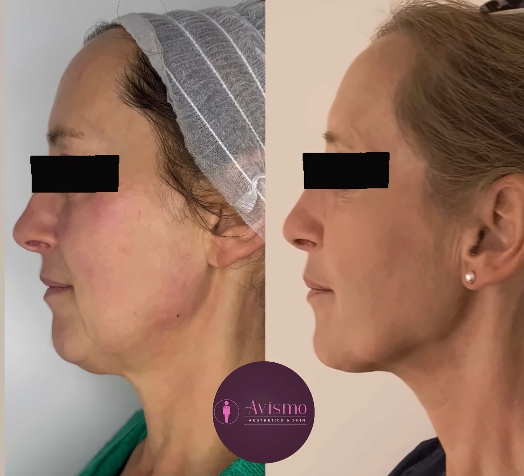 Before and after jawline and lower face with hifu at Avismo Aesthetics and Skin, St Ives