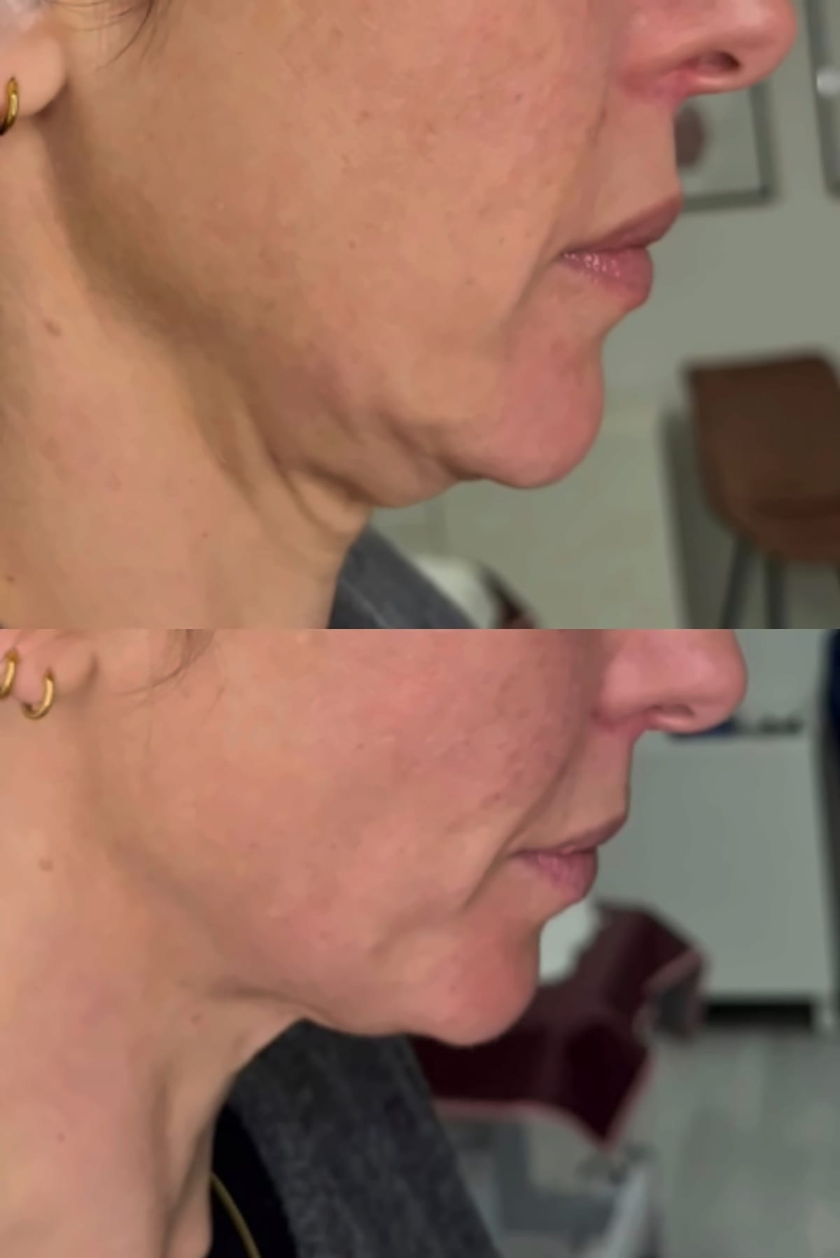 Before and after jawline and lower face with hifu at Avismo Aesthetics and Skin, St Ives