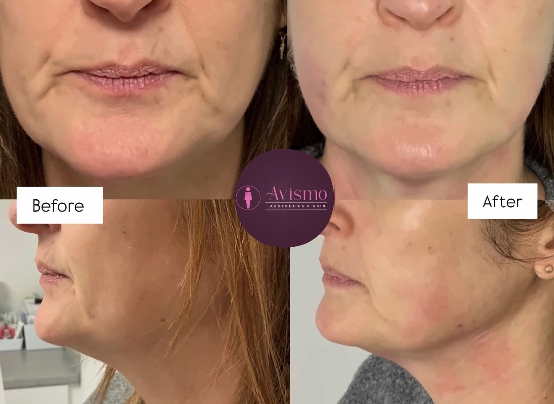 Before and after jawline and lower face with hifu at Avismo Aesthetics and Skin, St Ives
