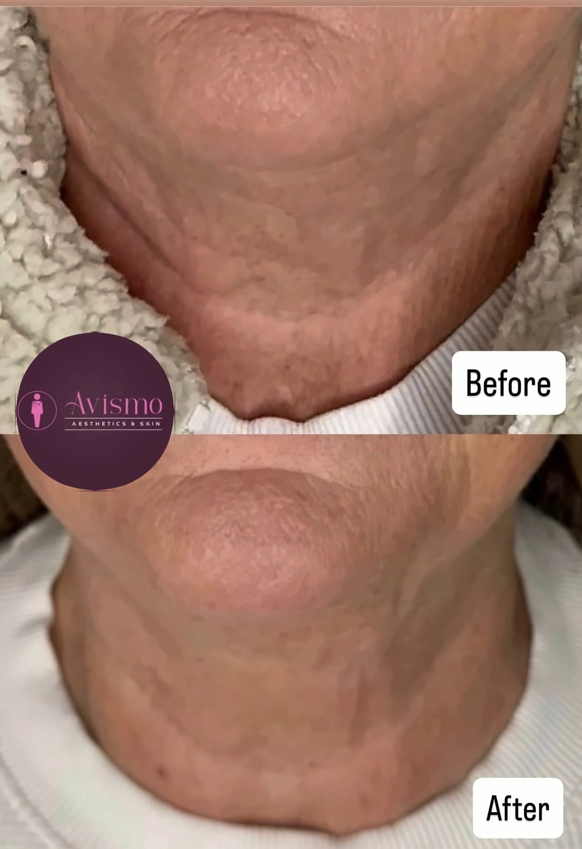 Before and after neck lines with hifu at Avismo Aesthetics and Skin, St Ives
