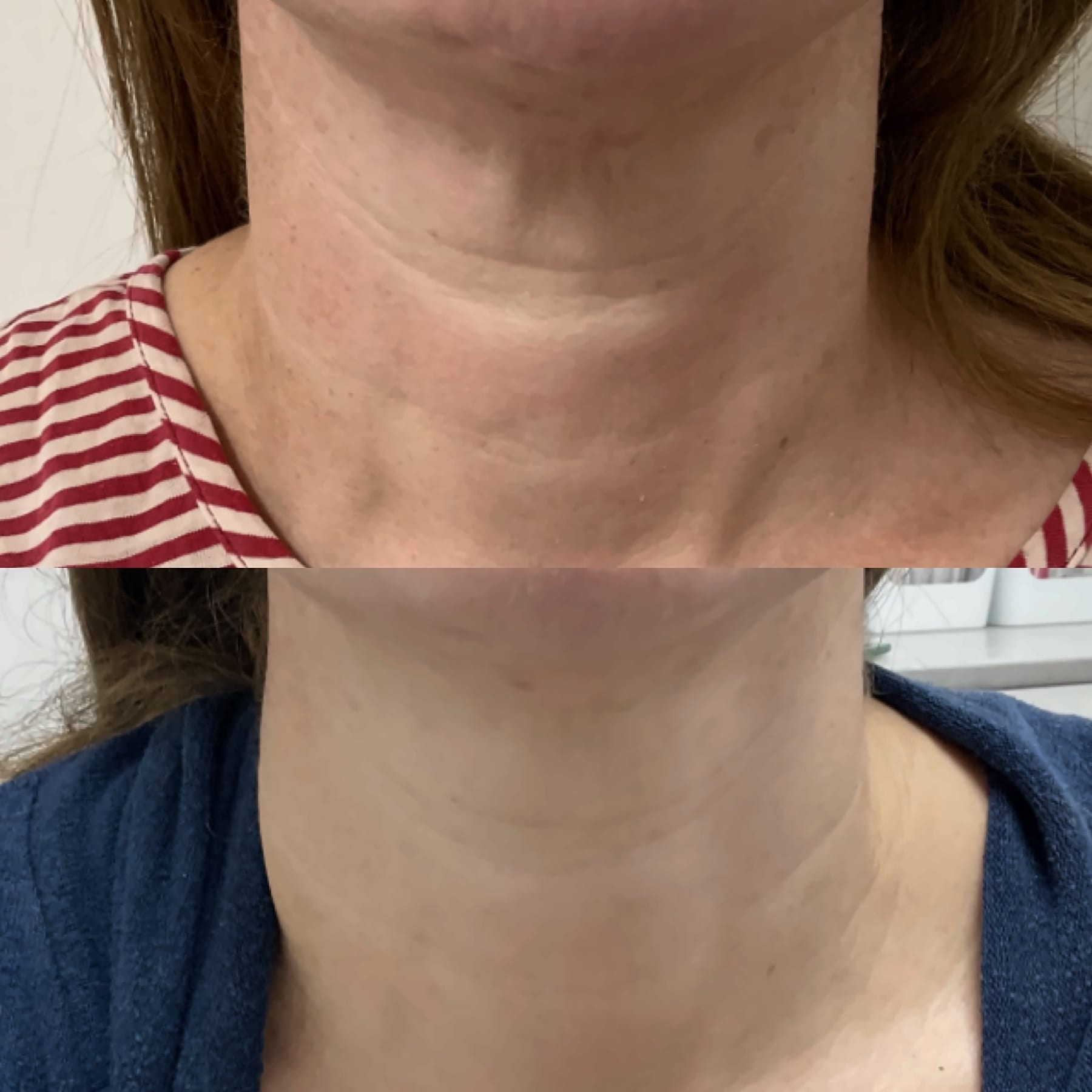 Before and after neck lines with profhilo at Avismo Aesthetics and Skin, St Ives
