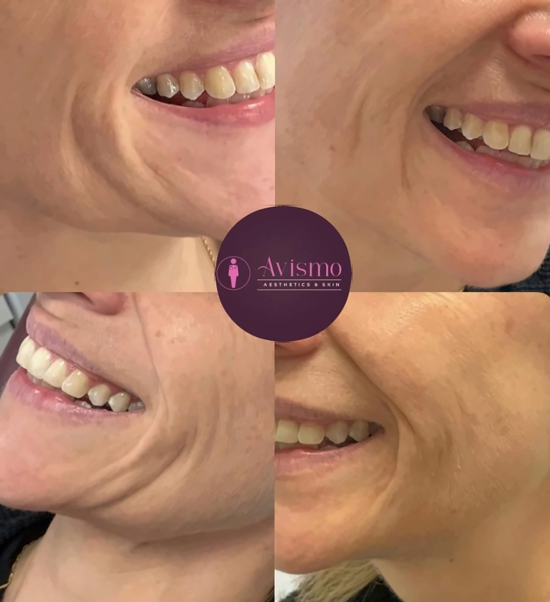 Before and after smile lines with rha 1 filler at Avismo Aesthetics and Skin, St Ives